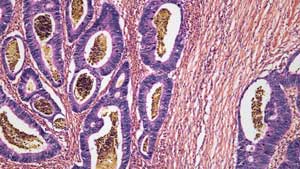 An image shows colon cancer cells.