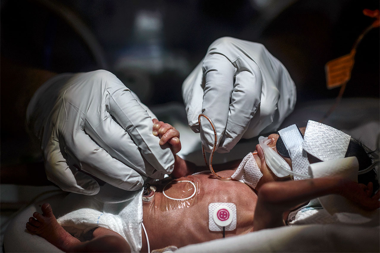gloved hands caring for a premature baby